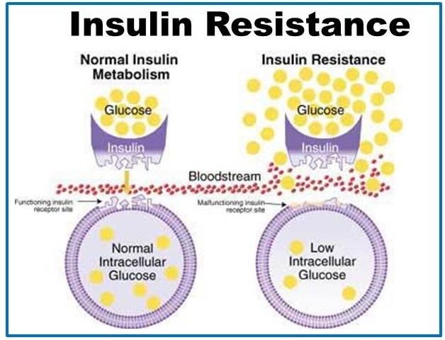 Insulinska rezistencija - preddijabetično stanje